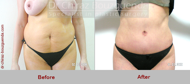 abdominoplasty before after pictures