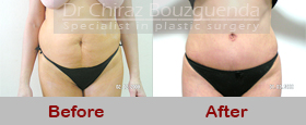abdominoplasty before after photos