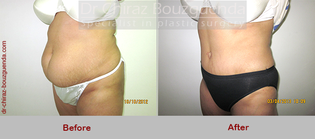 tummy tuck before after results