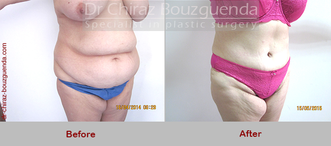 tummy tuck before after photos london