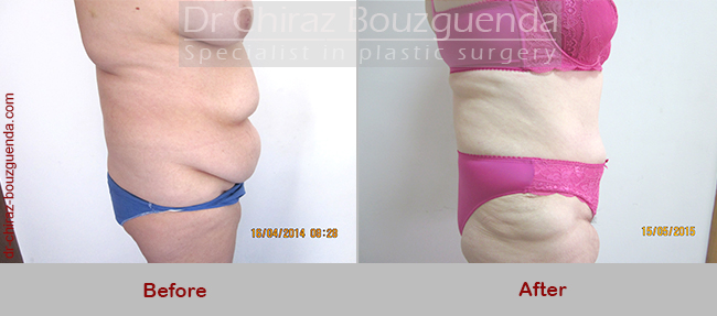 tummy tuck before after photos uk