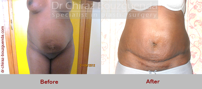 tummy tuck before after pictures abroad