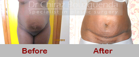 tummy tuck before after photos abroad
