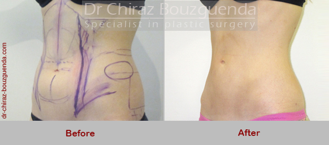 liposuction before after photos