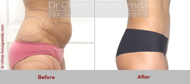 liposuction before after pictures