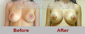 breast implant replacement before after photos