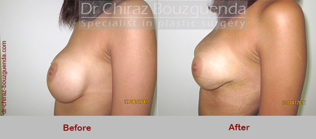 breast implants revision before after pictures