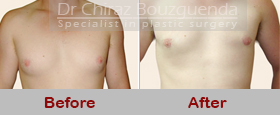 gynecomastia surgery abroad before after pics