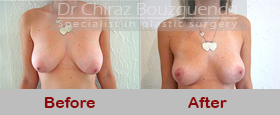 breast lift before after pictures
