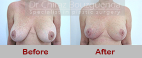 breast uplift before after