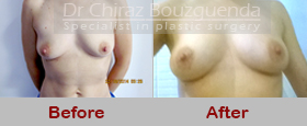 breast augmentation fat transfer before after