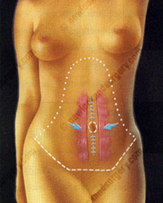 Dr Iraniha Redo Mini Tummy Tuck and Excision of Pseudo Bursa