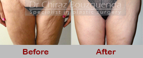 thigh lift before after pictures