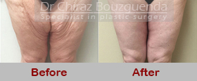 thigh lift before after results