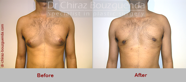 male breast reduction before after photos