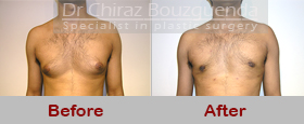 male breast reduction before after