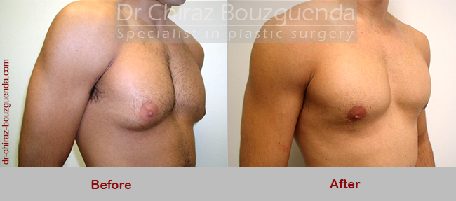 gynecomastia surgery before after pictures