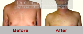 gynecomastia surgery abroad before after