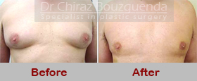 male breast reduction abroad before after results