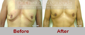 male breast reduction surgery before after photos
