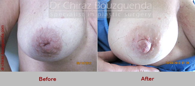 inverted nipple surgery before after